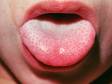This is the typical "white strawberry tongue" of scarlet fever, with a white coating with red dots on the surface.