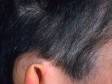 In a fungal infection of the scalp, there can be scaling without hair loss, as displayed in this image.