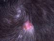 Tinea capitis (a fungal scalp infection) typically has round areas of hair loss with scaling and redness of the scalp.