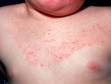 This image displays tinea (ringworm), which can be widespread with slight scaling and a relatively sharp edge to the area of involvement.