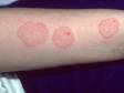 The round shape of tinea patches clearly reflects why it has the nickname ringworm. Note the slightly raised edge of the rings typical of tinea infections.