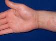 This image displays tinea manuum (hand fungus) with fine, white scaling and tinea corporis (body ringworm) with a circular lesion above the inner wrist.