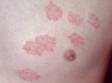 This image displays red, scaly, raised lesions of tinea corporis; these particular lesions are not in their usual ring-shaped form.