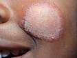 This image displays the round shape and pink, bumpy border of tinea on the face (ringworm).