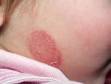 This image displays a classic occurrence of tinea faciale (ringworm) on the neck.