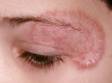 The pink rings with scaling seen around the eye are classic of tinea faciale.