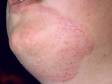 This image displays the superficial skin fungal infection of the face known as tinea faciale.
