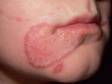 Tinea faciale (a fungal infection on the face) often has pink, ring-like, slightly elevated lesions with scaling at the edge.