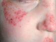 Tinea of the face can cause red, scaly, raised skin lesions.