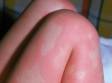 Urticaria (hives) can consist of large areas of redness and welt-like skin lesions.
