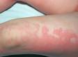 This image displays pink areas of a rash surrounded by lighter areas (due to constriction of blood vessels) typical of urticaria (hives).