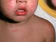 This image displays widespread urticaria (hives) involving the face.