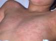 This image displays widespread urticaria (hives).