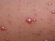 The blisters of varicella (chickenpox) are usually small and filled with a clear fluid.