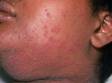 This image displays how a viral rash with tiny blisters may affect the mucous membranes (see the lips).