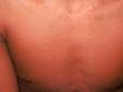 This viral rash shows overall redness of the trunk as well as prominence of the hair follicles (above the nipple area).