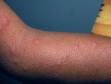 This image displays how some lesions from viral exanthem may develop into blisters.