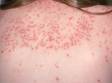 This image displays how sun exposure worsens a viral rash, as in this child on the upper back.