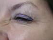 AFTER: Crow's feet 1 week after Botox injection, with the patient squinting.
