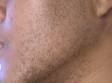 BEFORE: The cheek of a patient with ethnic skin before laser hair removal.