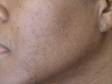 AFTER: The cheek of a patient with ethnic skin after laser hair removal (in this instance, by 6 treatments with a long-pulsed Nd:YAG laser).