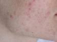 BEFORE: This patient wanted laster skin renewal to improve the appearance of acne scars on his cheeks.