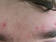 BEFORE: This patient wanted the appearance of his acne scars on his forehead minimized by laser treatment.