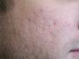 BEFORE: This patient wanted the appearance of his acne scars minimized by laser treatment.