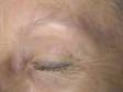 AFTER: An eyebrow post laser tattoo removal.