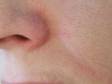 AFTER: A nose immediately after laser treatment for vascular lesions (in this instance, by a long-pulsed Nd:YAG laser).
