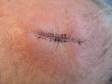 AFTER: After Mohs micrographic surgery, the skin is often repaired with sutures, as seen here.