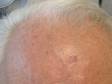 BEFORE: Skin cancer can be seen on the right portion of this patient's forehead. This image was taken prior to Mohs micrographic surgery.