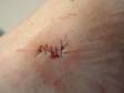 During suturing, the wound is cleaned and then pulled together with sutures, also known as stitches, to decrease healing time and allow the skin to heal with less scarring.