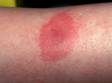 Redness, pain, and swelling may follow an insect bite.