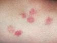 Bedbug bites are often clustered near each other on the skin.