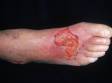 This severe burn on the top of the foot was caused by a hot grease spill.