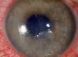 This classic abrasion demonstrates the typical ragged edge of a corneal abrasion.