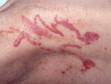 Jellyfish Stings, First Aid: Condition, Treatments, and Pictures - First Aid Guide | skinsight