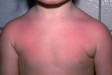 Sunburns on the shoulders and upper chest are very common and range in color from pink to red.