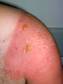 Severe sunburns such as this one often result in blistering.