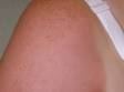 Skin can become blistered following a severe sunburn.