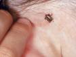 It is important to inspect the skin after being outdoors in wooded or grassy areas. Ticks often hide in obscured areas, such as around the hairline or elsewhere on the scalp.