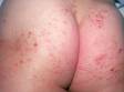 This image displays small, separate bumps with red lesions (due to scratching) from atopic dermatitis (eczema).