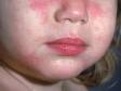 Atopic dermatitis (eczema) can involve the face and scattered body areas, as in this child.