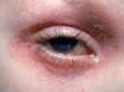 This image displays severe atopic dermatitis (eczema) on a child's eyelids.