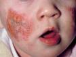 This image displays large, crusted lesions with erosions in a severe case of atopic dermatitis (eczema).