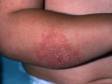 This image displays scaling, dry, slightly elevated lesions typical of atopic dermatitis (eczema).