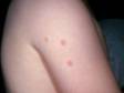 Bedbug bites cause pink, round, small, slightly raised areas on the skin.