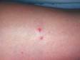 Bedbugs can cause small, red, itchy bumps.