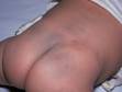 Blue-gray spots (Mongolian spots) appear as gray to blue colored, flat, "bruise-like" areas of skin.
